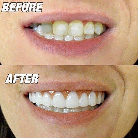 Perfect Instant Smile